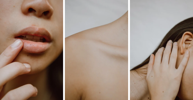 Sclerotherapy